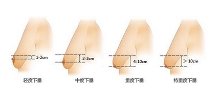 乳房下垂程度