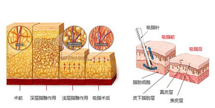 吸脂原理