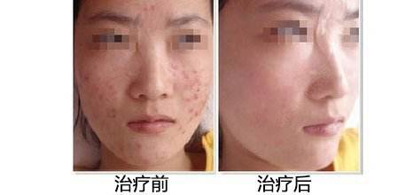 上海艺星祛痘印效果