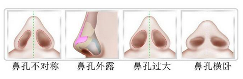 上海鼻头缩小价格是多少