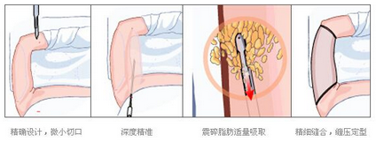 手臂吸脂原理