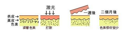 激光去晒斑原理