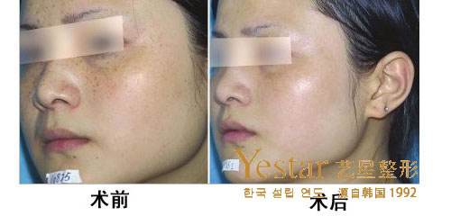 上海艺星去雀斑效果