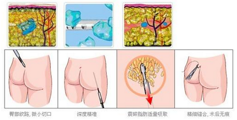 臀部吸脂手术会留疤吗