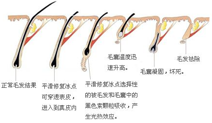 激光脱毛原理