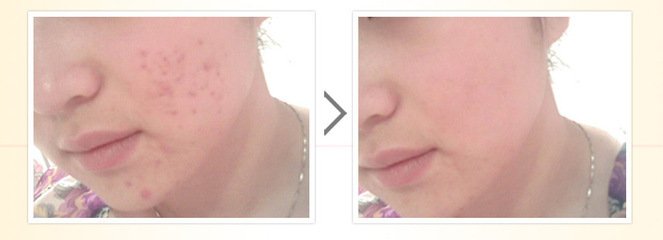 激光能治疗痘印吗