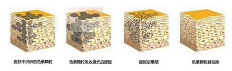 激光去咖啡斑原理