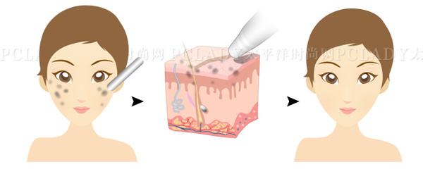 上海激光祛斑价格多少