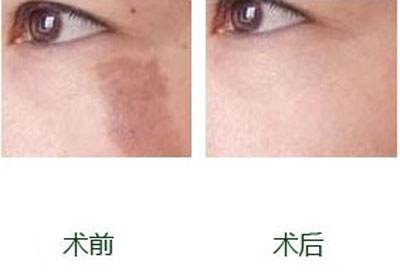 上海祛咖啡斑多少钱