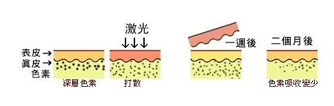 激光治疗咖啡斑的原理