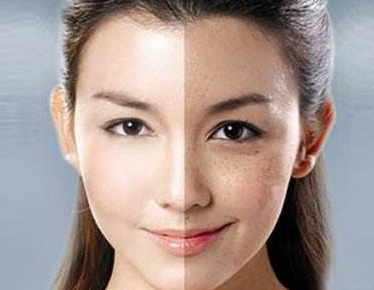 上海激光去雀斑哪家好