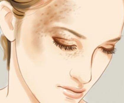 光子祛除太田痣的效果好吗