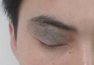 光子祛除太田痣的效果好吗