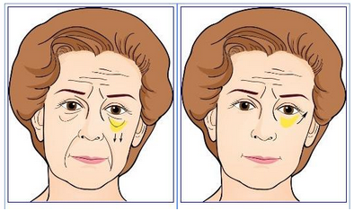 眼袋吸脂效果