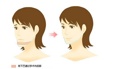 隆下巴整形有没有效果