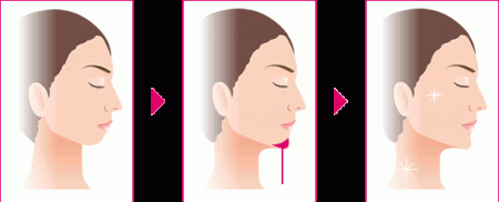 垫下巴手术是怎么进行的
