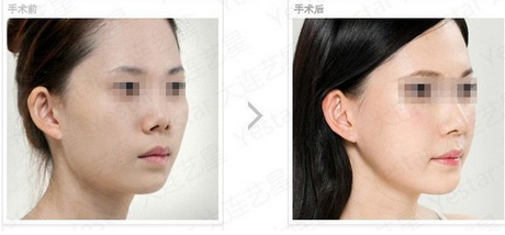 艺星垫下巴效果