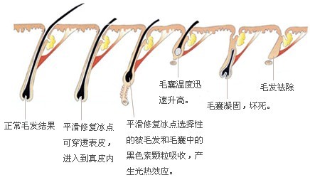 冰点脱毛过程