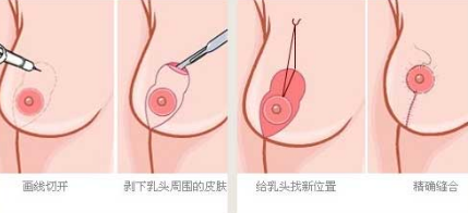 乳房下垂矫正手术