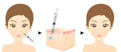 玻尿酸去法令纹