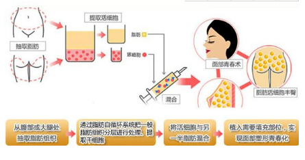 自体脂肪去除额头上的皱纹