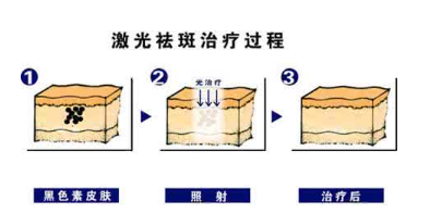 激光祛斑过程