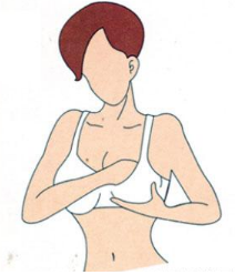 副乳切除