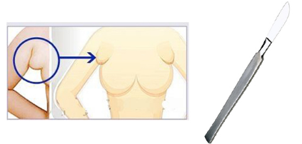 手术副乳切除