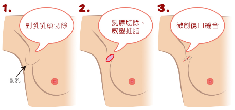 副乳切除