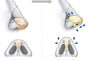 鼻头缩小手术方法