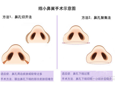 鼻头缩小手术