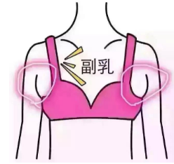 副乳切除