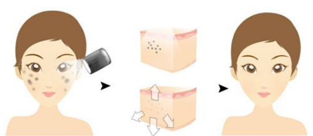 使用彩光嫩肤美容有副作用吗