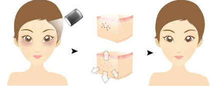 黑眼圈可以用激光去掉吗