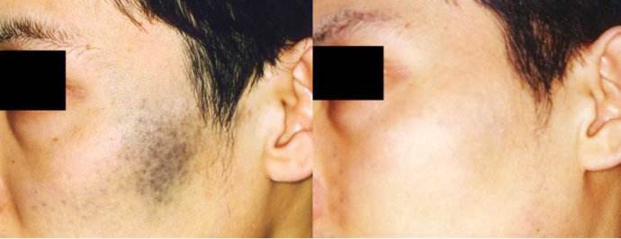 太田痣难去掉吗