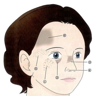 太田痣难去掉吗