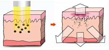 太田痣治疗前后对比