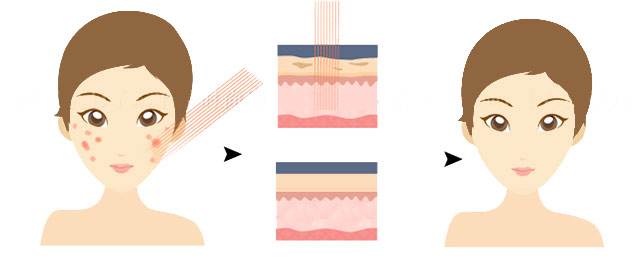 怎么样去痘印呢