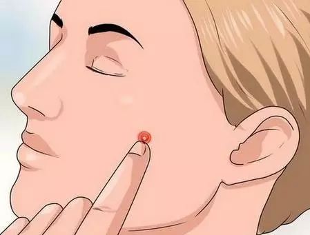 哪个方法能去痘印的