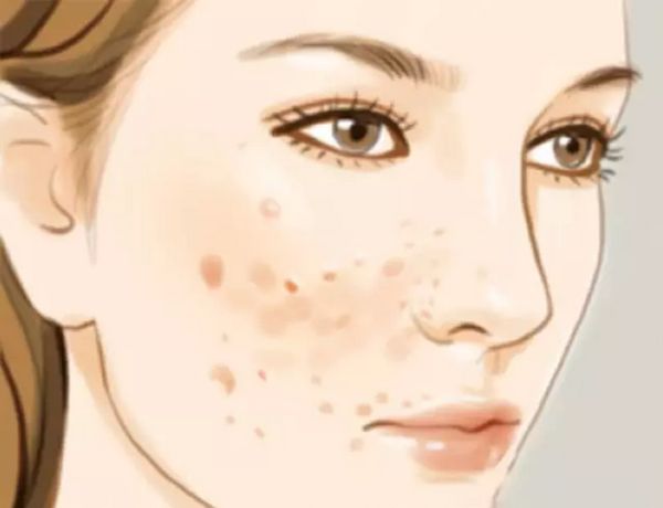 哪个方法能去痘印的