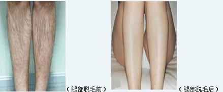 激光能不能脱腿毛