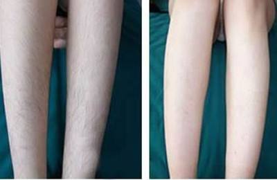激光能不能脱腿毛