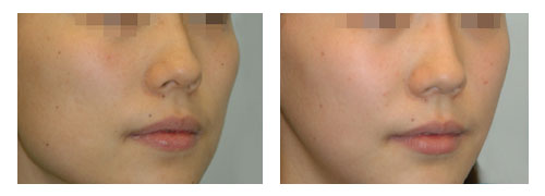 上海激光脱唇毛哪个季节好