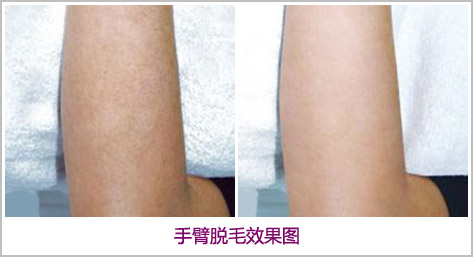 上海艺星手臂脱毛痛不痛