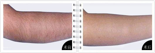 怎么快速手臂脱毛