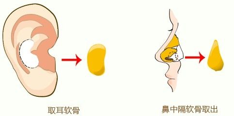 哪些情况需要鼻小柱整形