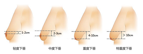 哪些因素影响韩式丰胸价钱