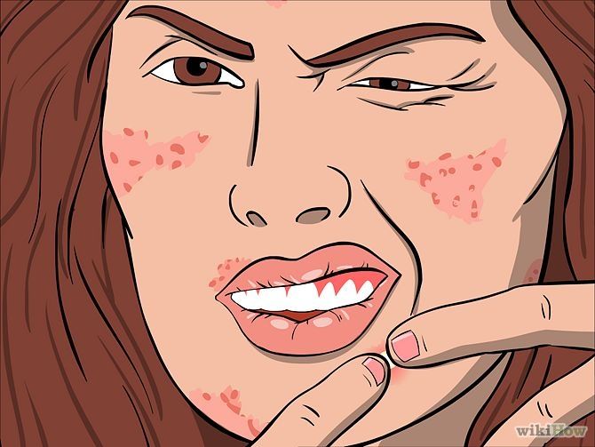 激光去痘坑的治疗费用高吗