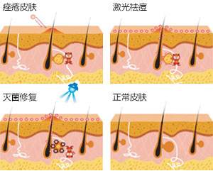 激光治疗痤疮的价格高不高