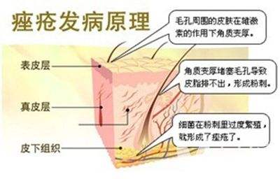 脸上痤疮疤痕太多怎么办